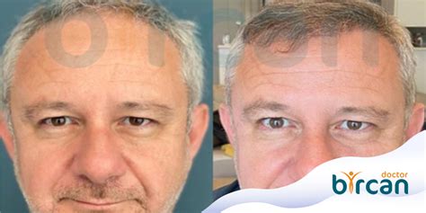 КАК СДЕЛАТЬ ПЕРЕСАДКУ ВОЛОС НА СЕДЫХ ВОЛОСАХ? » Dr. Gökhan Bircan
