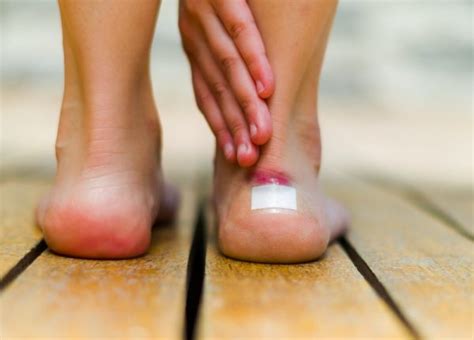 how to treat an open blister on foot