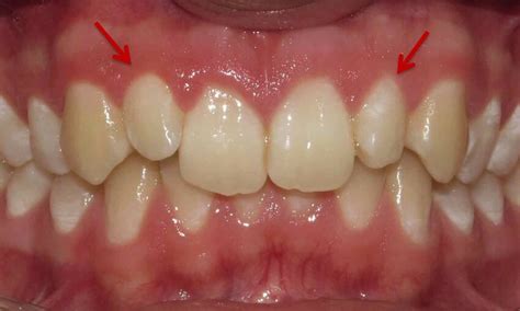 Bilateral partial microdontia of the upper lateral incisors. | Download ...