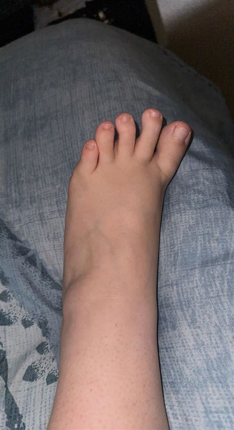 Big blue veins over feet! : r/medical_advice