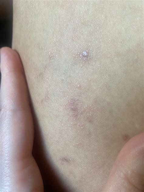 Spreading rash first thought was spider veins : r/DermatologyQuestions