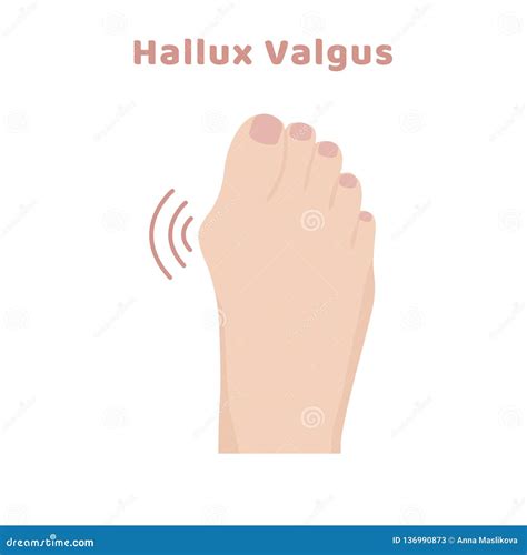 Deformity Bunion Bone of Toe - Hallux Valgus. Orthopedic Disease Stock