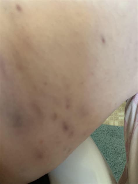 How to reduce scarring? : r/Hidradenitis