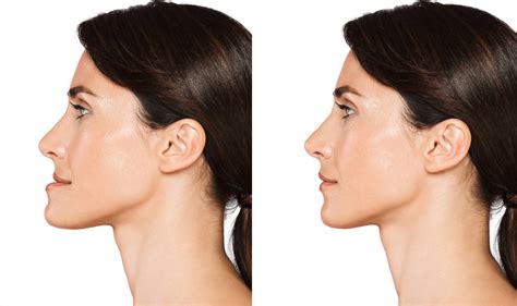 how to fix protruding chin