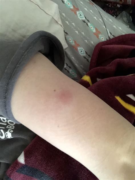 What Is A Lump In My Arm at Annabelle Parkhill blog