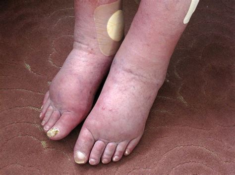 Edema - Cardiovascular Disorders - Merck Manual Professional Edition