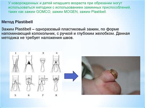 Фимоз и парафимоз у детей - презентация онлайн