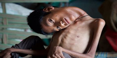 dogustan boynu  derece egri olan cocuga care  bin  mil oeteden geldi