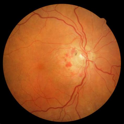 systemic causes of disc hemorrhage – Los Alamos Family Eyecare, P.C.