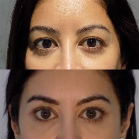 Blepharoplasty | Dr Fiumara 5* Natural Results