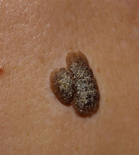seborrheic keratosis hayleys hair removal  aesthetics poole