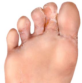 Athlete's Foot (foot fungal infection) | Spine & Orthopedic Center