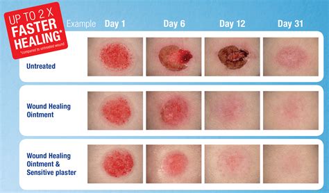 moist wound healing wound care elastoplast