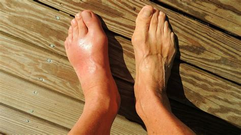 HOW TO GET RID OF GOUT PAIN IN FOOT | Programsrun.com