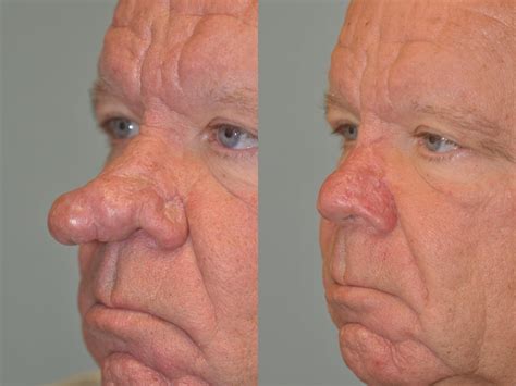 Rhinophyma after treatment with Laser | Eugene Alford | Flickr