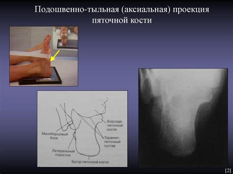 Стопа в боковой проекции - online presentation
