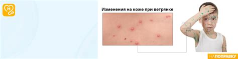 Ветрянка у детей и взрослых: фото, симптомы, лечение. Как выглядит ...