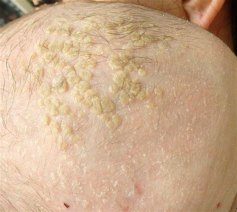 seborrheic dermatitis pediatric dermatology