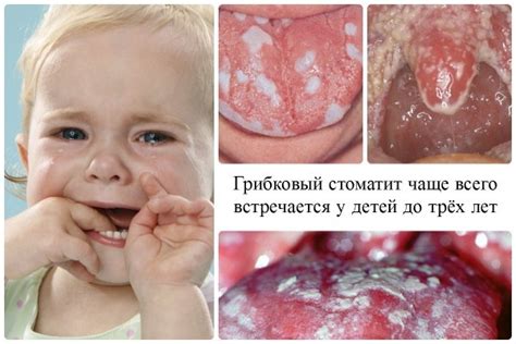 Молочница у новорожденных во рту: симптомы, лечение
