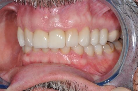 vertical dimension  occlusion dr furgurson
