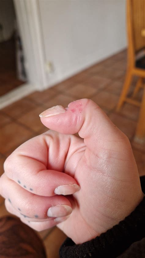 My nails are so deformed and damaged... : r/Dermatophagia