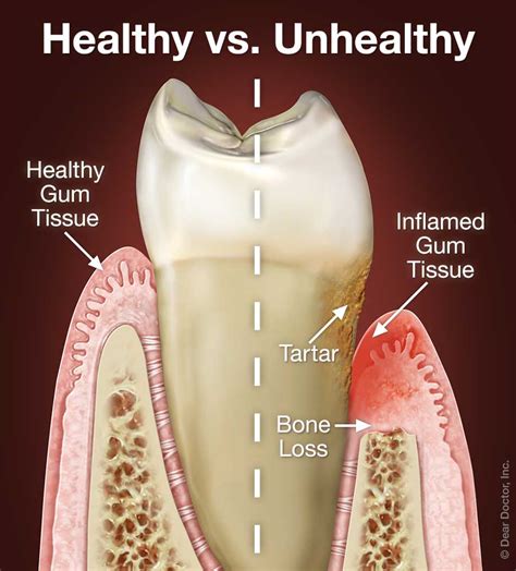 how to know if i have periodontal disease