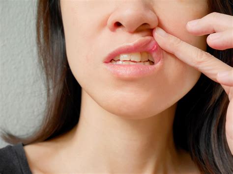 Why Are My Lips Red And Sore Inside | Lipstutorial.org