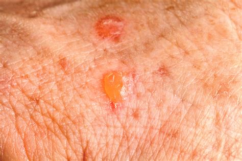 Pre Skin Cancer Keratosis