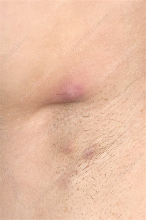 Abscess Armpit