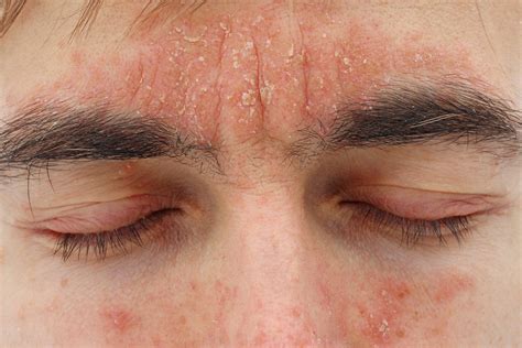seborrheic dermatitis dermatitis treatment seborrheic vrogueco