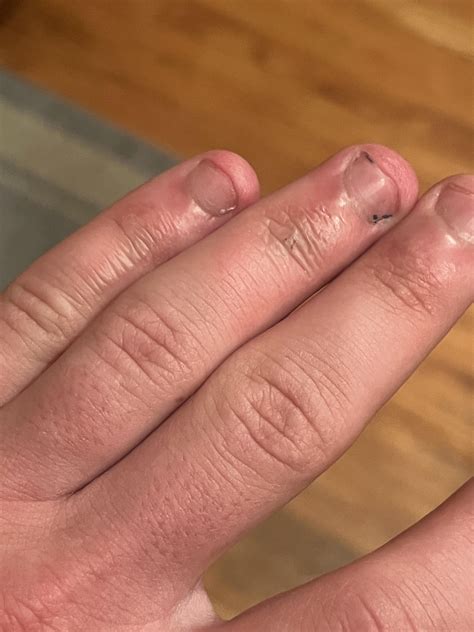 These burns were extremely painful to the point where I could only