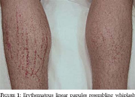 Figure 1 from Shiitake dermatitis | Semantic Scholar