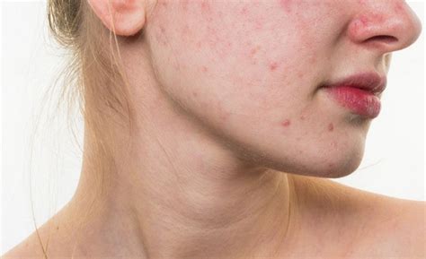 Acne Vulgaris Treatment in Delhi, West Delhi - Skinology