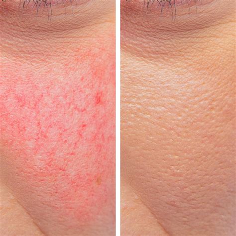 Laser Spider Vein Removal - Medical Spa Services - Santa Rosa