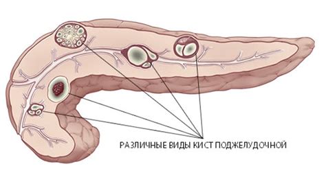 Киста поджелудочной железы: симптомы и лечение, причины и разновидности