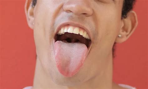 coated tongue symptoms  treatment curaprox