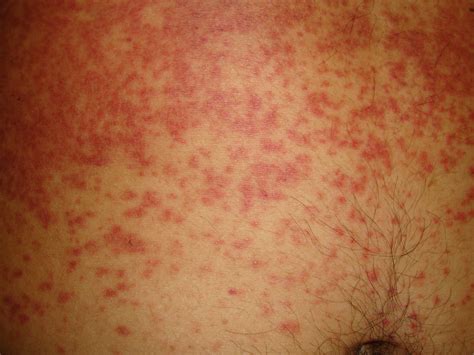 Clinical Features And Etiology Of Adult Patients With Fever And Rash