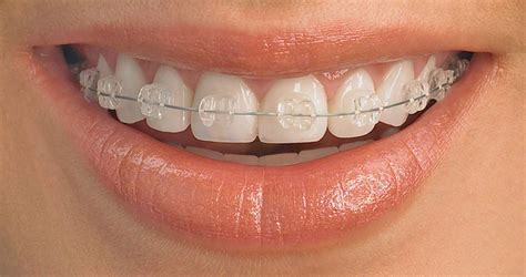 ceramic braces  burnley solution  straighter teeth queensgate