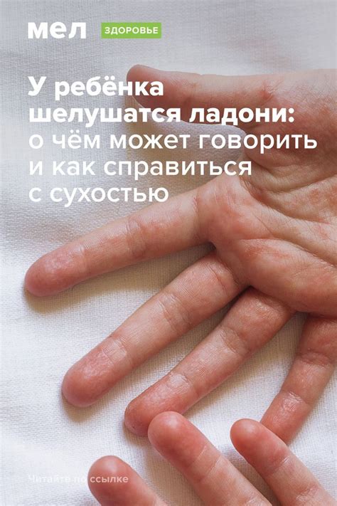 У ребёнка шелушатся ладони: о чём это может говорить и как справиться с ...