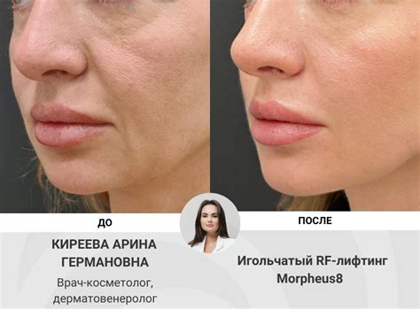 Игольчатый RF-лифтинг Morpheus8/Морфеус в Москве. Выгодные цены в ...