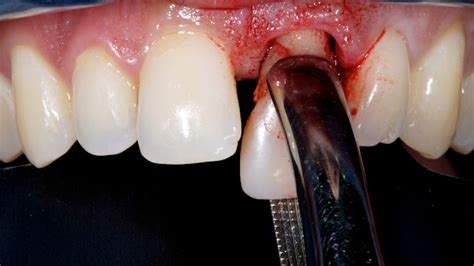 Tooth Extraction and Healing - All You Should Know