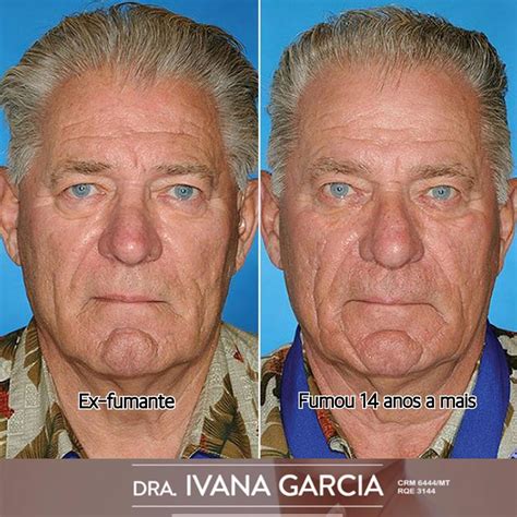 Pele Antes E Depois De Parar De Fumar - Os Efeitos do Cigarro na Pele :: Dra Ivana Garcia - Dermatologista