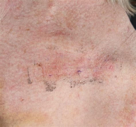 Squamous Cell Skin Cancer Removal Surgery - Infoupdate.org