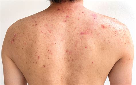 Top 5 Ways to Treat Back Acne or Bacne