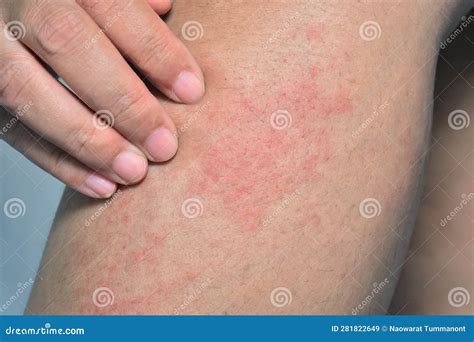 itchy leg rash rashes  babies  children nhs