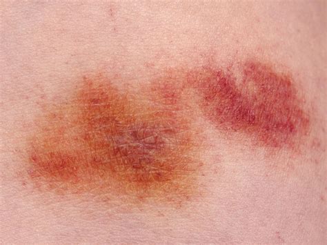 How To Treat A Painful Bite With A Bruise Around It Using Simple Home Care Remedies 1