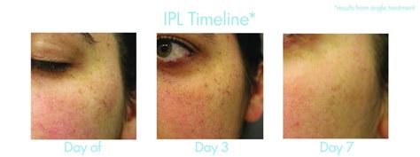 IPL Fotofacials Remove Dark Spots On The Skin?