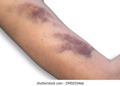 Bruise On Skin Womans Upper Arm Stock Photo 1990255466 | Shutterstock