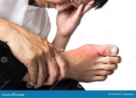 Man with Painful and Inflamed Gout on His Foot, Around the Big Toe Area ...