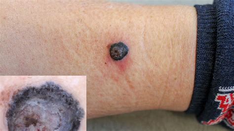 Nodular Melanoma Pictures: Symptoms, Treatment, and More